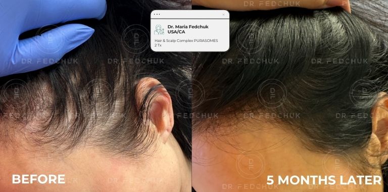 Before and after — regenerative protocol clinical example 10