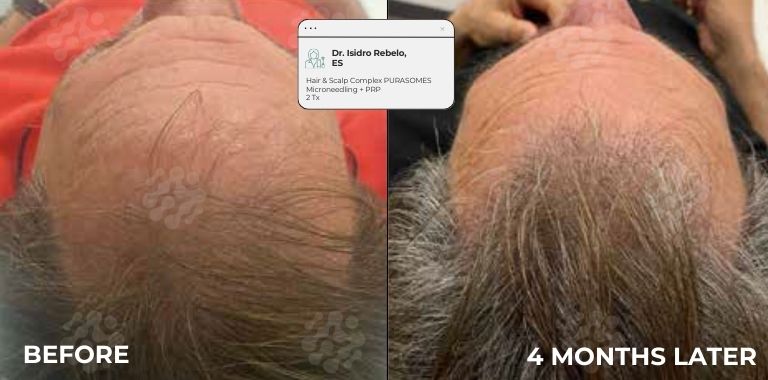 Before and after — regenerative protocol clinical example 7