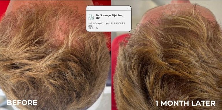 Before and after — regenerative protocol clinical example 6