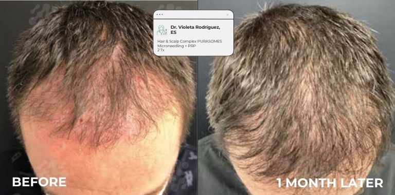 Before and after — regenerative protocol clinical example 8