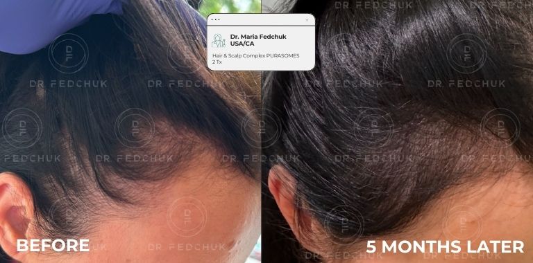 Before and after — regenerative protocol clinical example 9