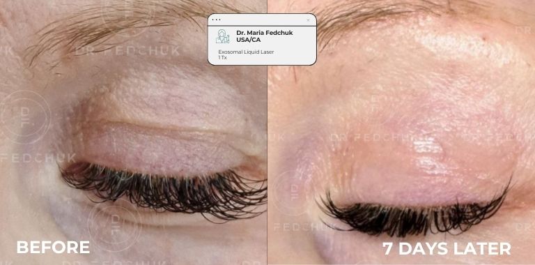 Before and after — regenerative protocol clinical example 13