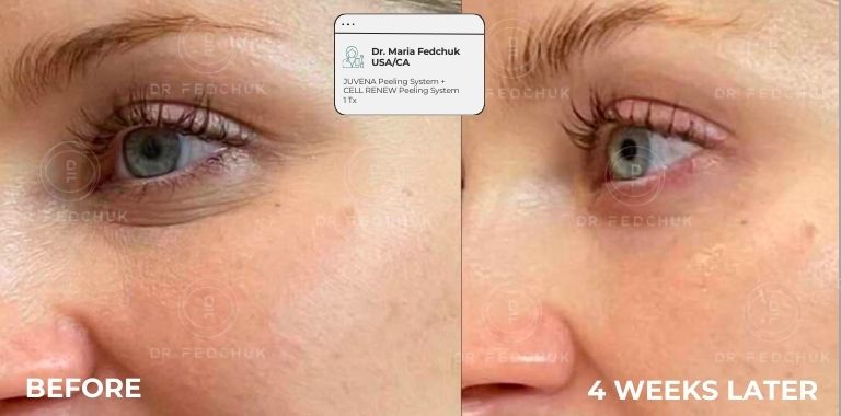 Before and after — regenerative protocol clinical example 1