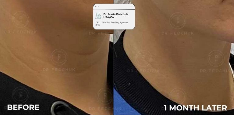 Before and after — regenerative protocol clinical example 2