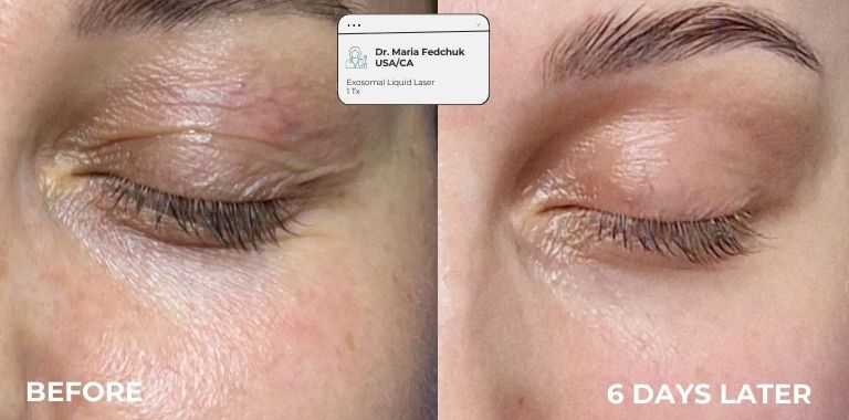 Before and after — regenerative protocol clinical example 4