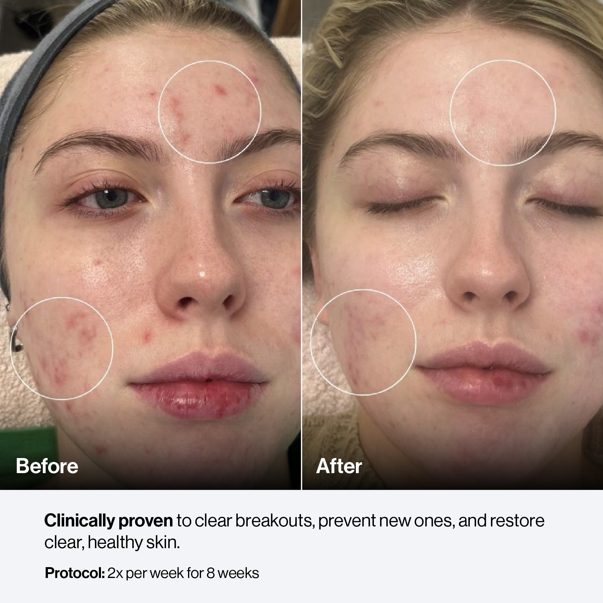 Before and after — Celluma acne result