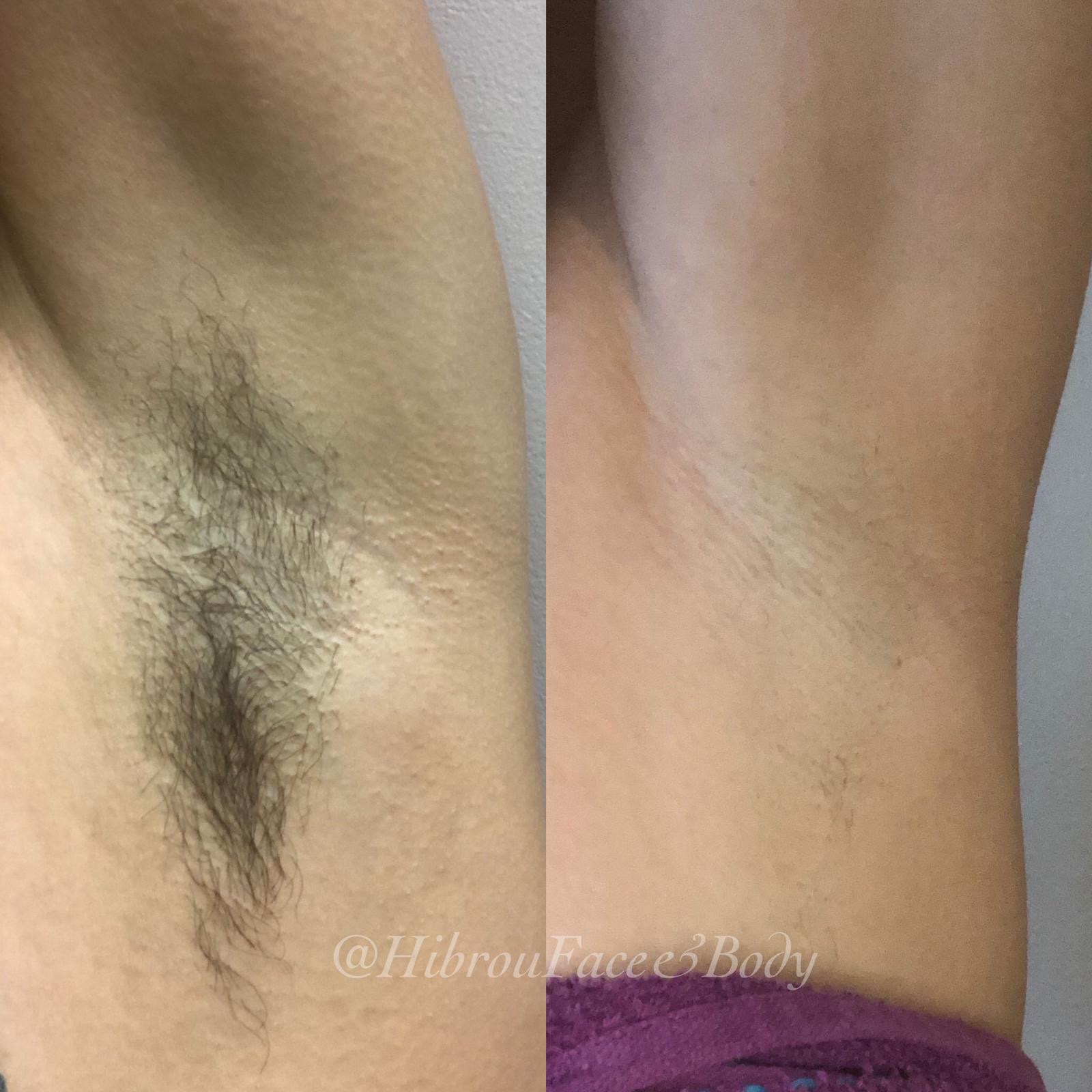 Before and after — real Epilfree client result