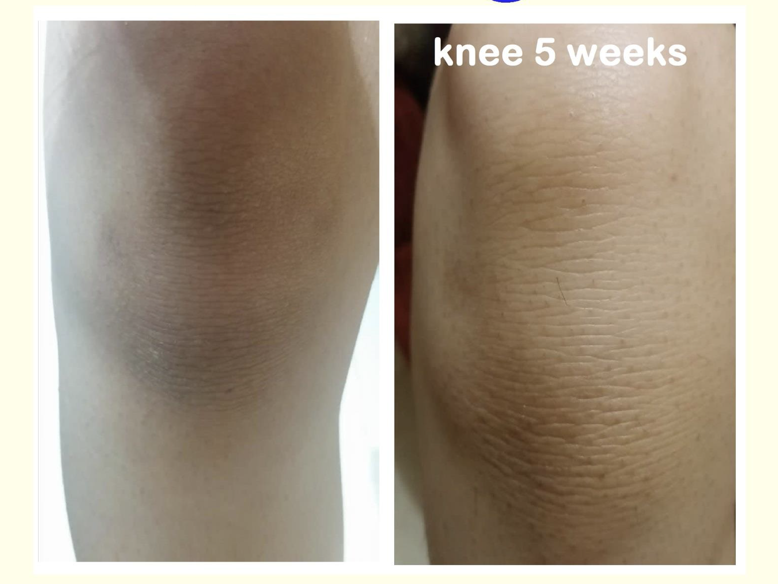 Before and after — real Epilfree client result