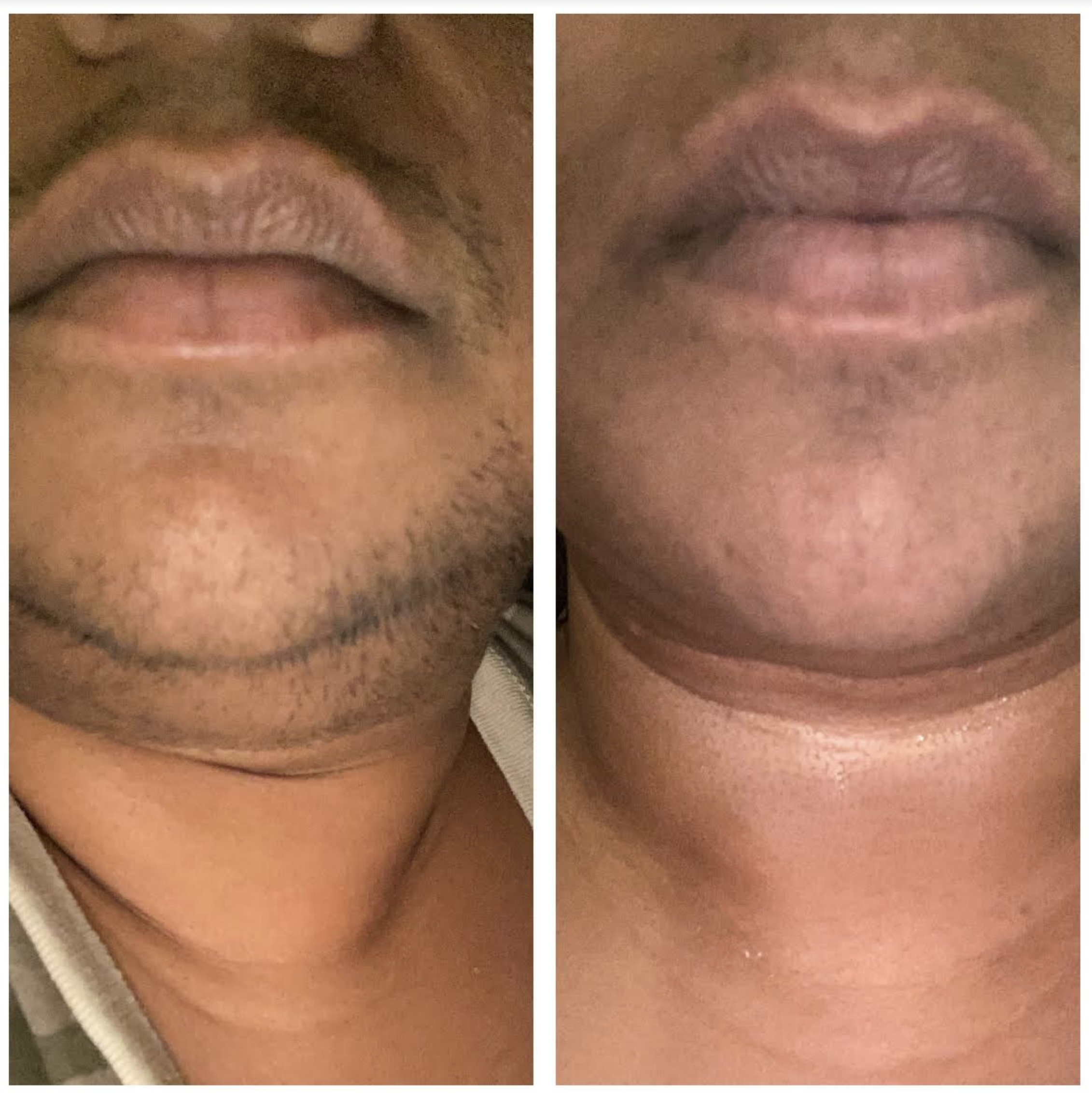 Before and after — real Epilfree client result