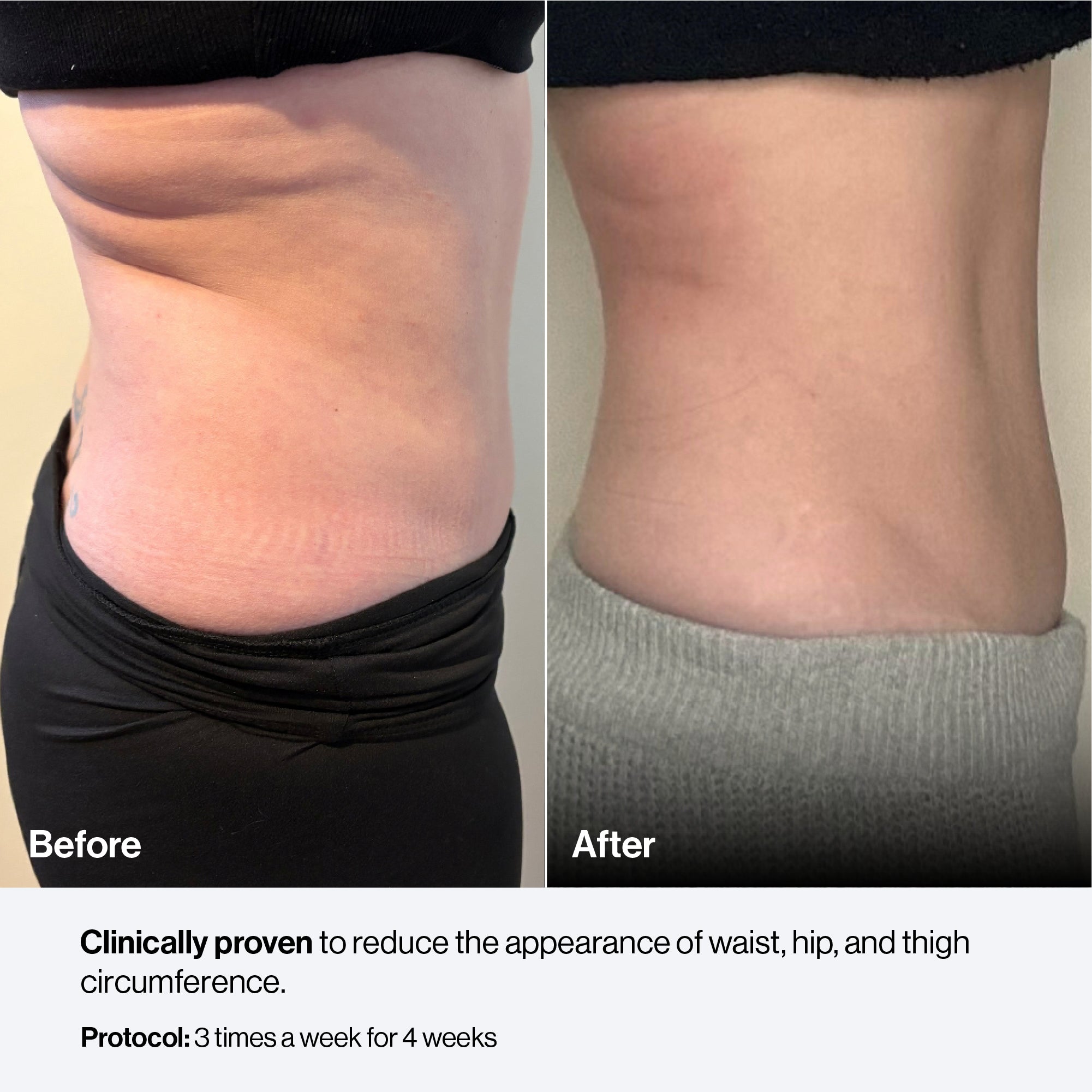 Before and after — Celluma body contouring result