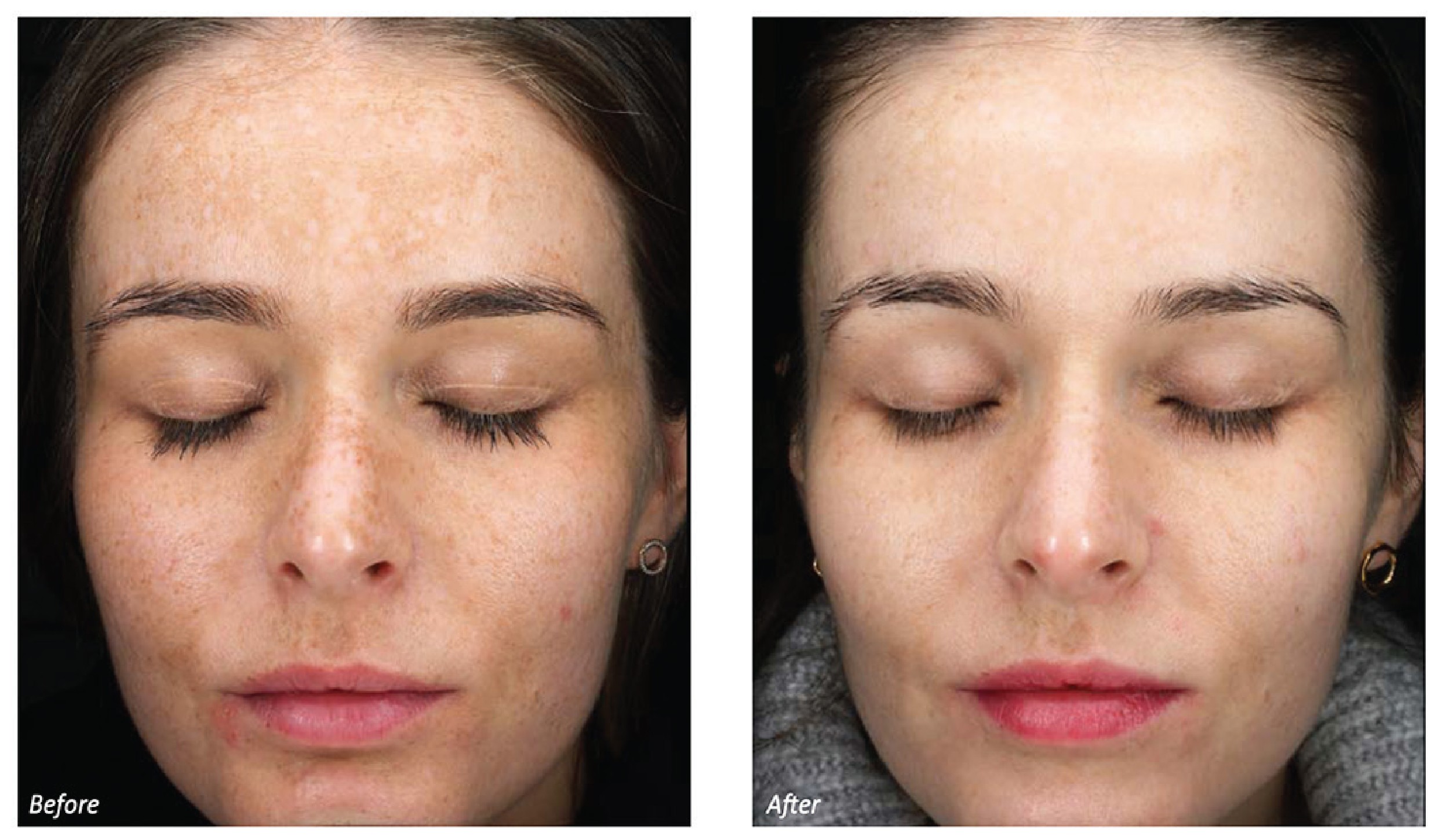 Before and after — Dermafrac result