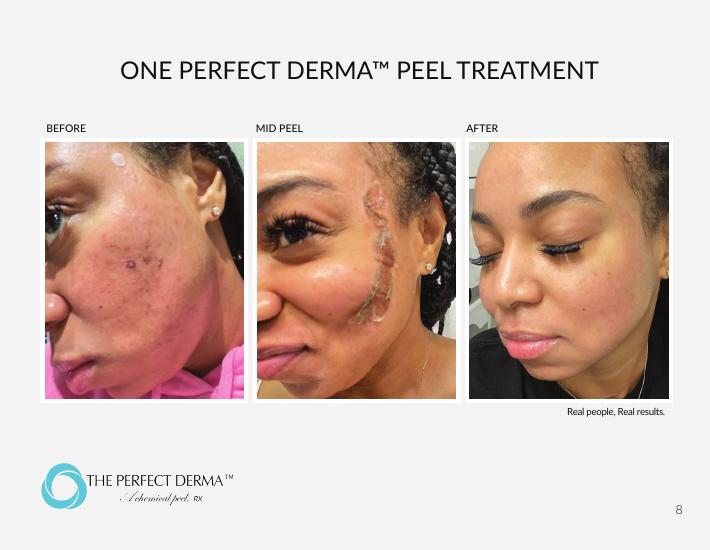 One Perfect Derma Peel treatment — before, mid-peel, and after