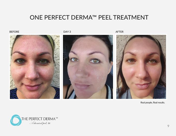 One Perfect Derma Peel treatment — before, day 3, and after