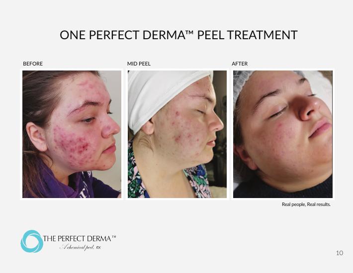 One Perfect Derma Peel treatment for active acne — before, mid-peel, and after