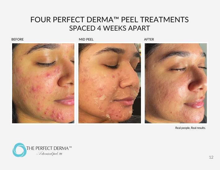 Four Perfect Derma Peel treatments spaced four weeks apart — before, mid-peel, and after