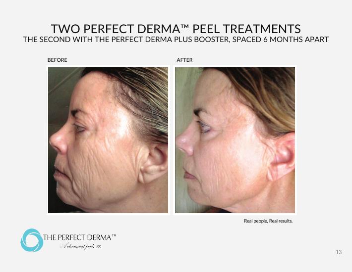 Two Perfect Derma Peel treatments six months apart — before and after
