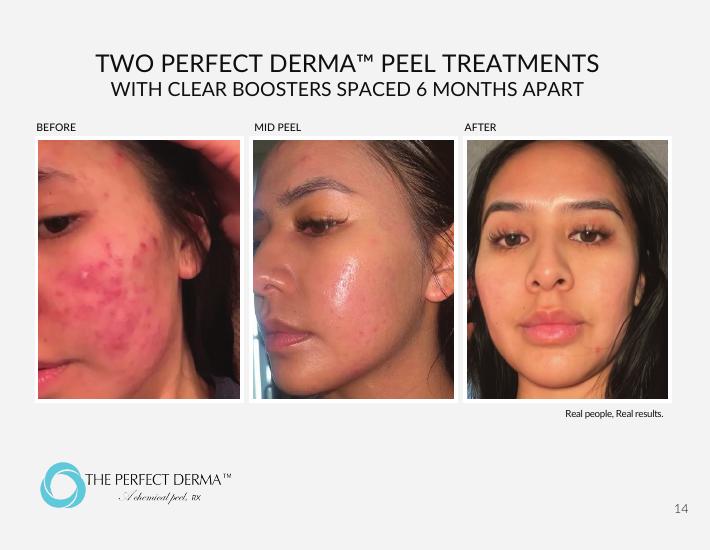 Two Perfect Derma Peel treatments with Clear Boosters — before, mid-peel, and after