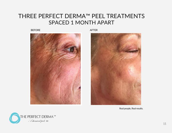 Three Perfect Derma Peel treatments spaced one month apart — before and after