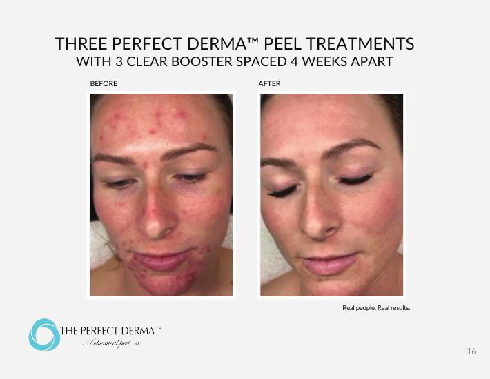 Three Perfect Derma Peel treatments with Clear Booster — before and after