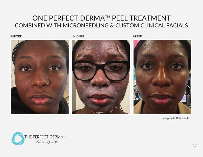 One Perfect Derma Peel combined with microneedling — before, mid-peel, and after