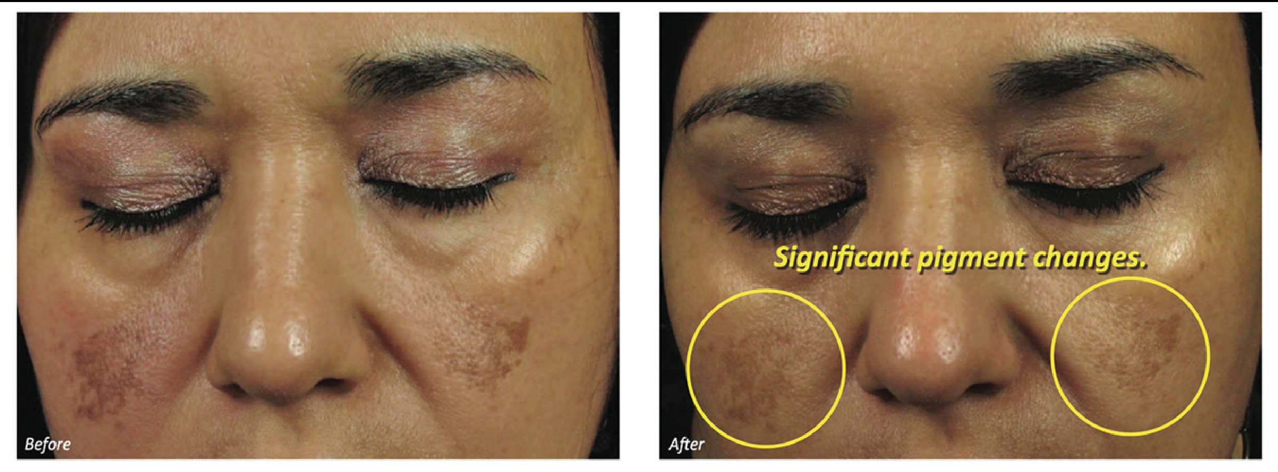Before and after — Dermafrac result