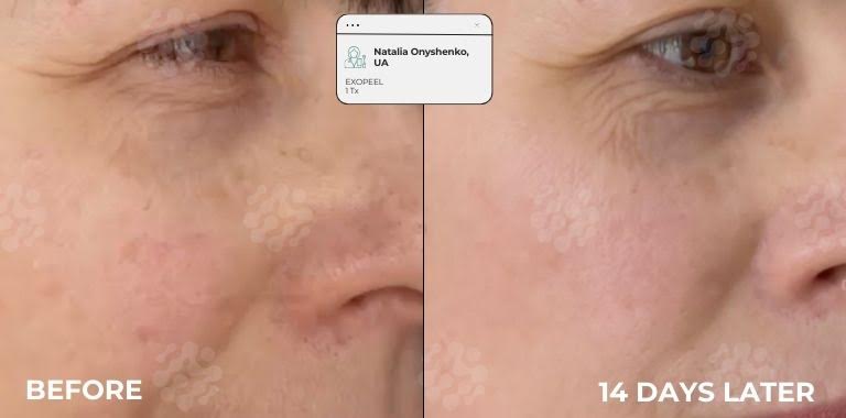 Microneedling client result — skin transformation after Purasomes protocol