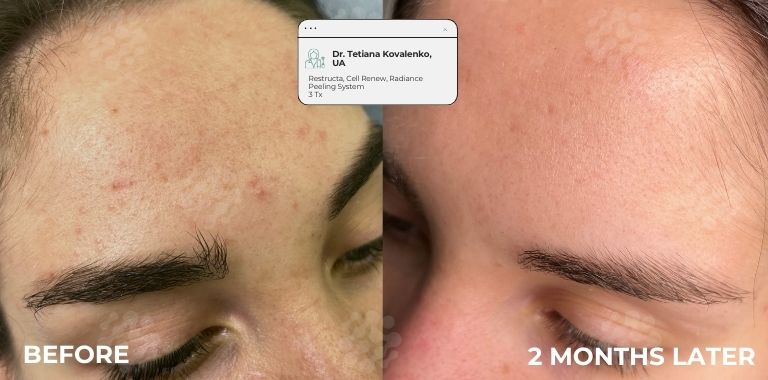 Before and after — 2 MONTHS LATER