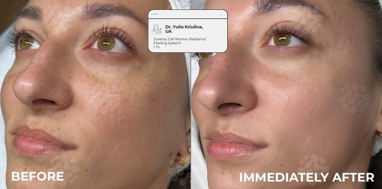 Before and after — IMMEDIATELY AFTER