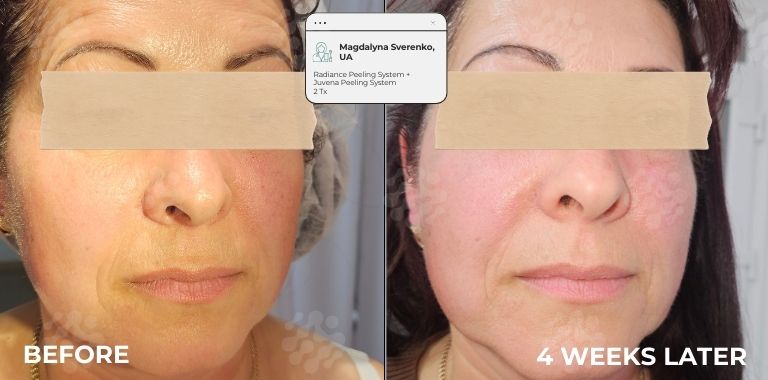 Before and after — 4 WEEKS LATER