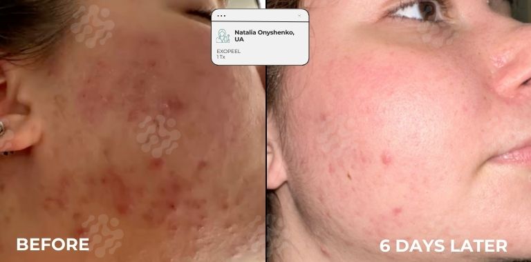 Before and after — 6 DAYS LATER