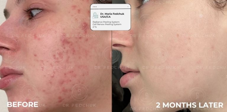 Before and after — 2 MONTHS LATER