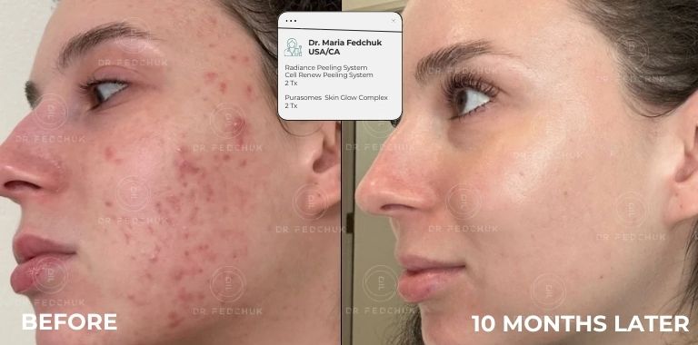 Before and after — 10 MONTHS LATER