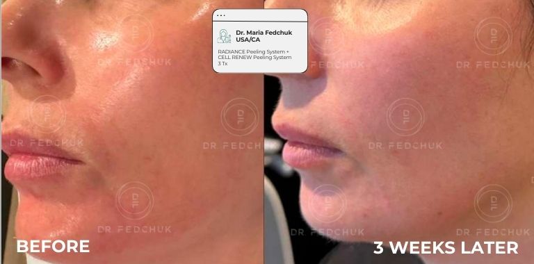 Before and after — 3 WEEKS LATER