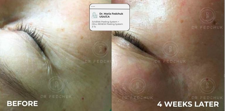 Before and after — 4 WEEKS LATER