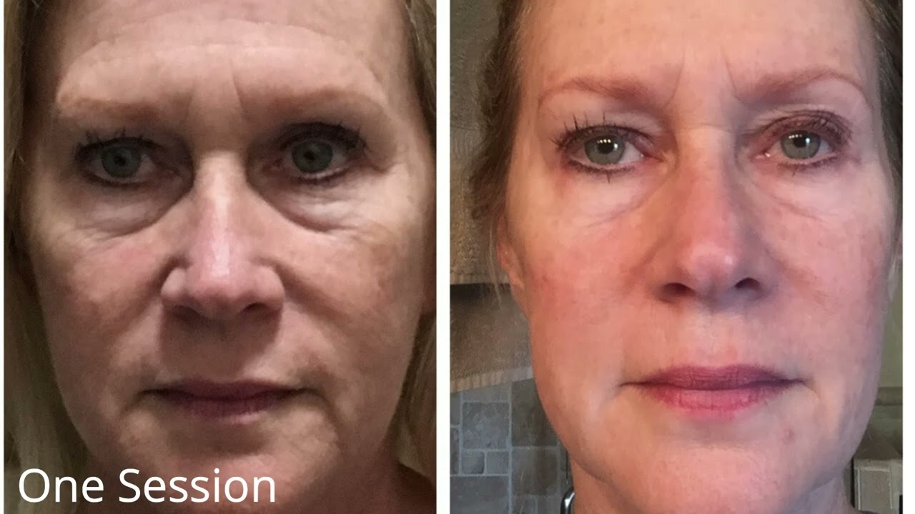 TAMA Blue Onyx microcurrent facial lifting session