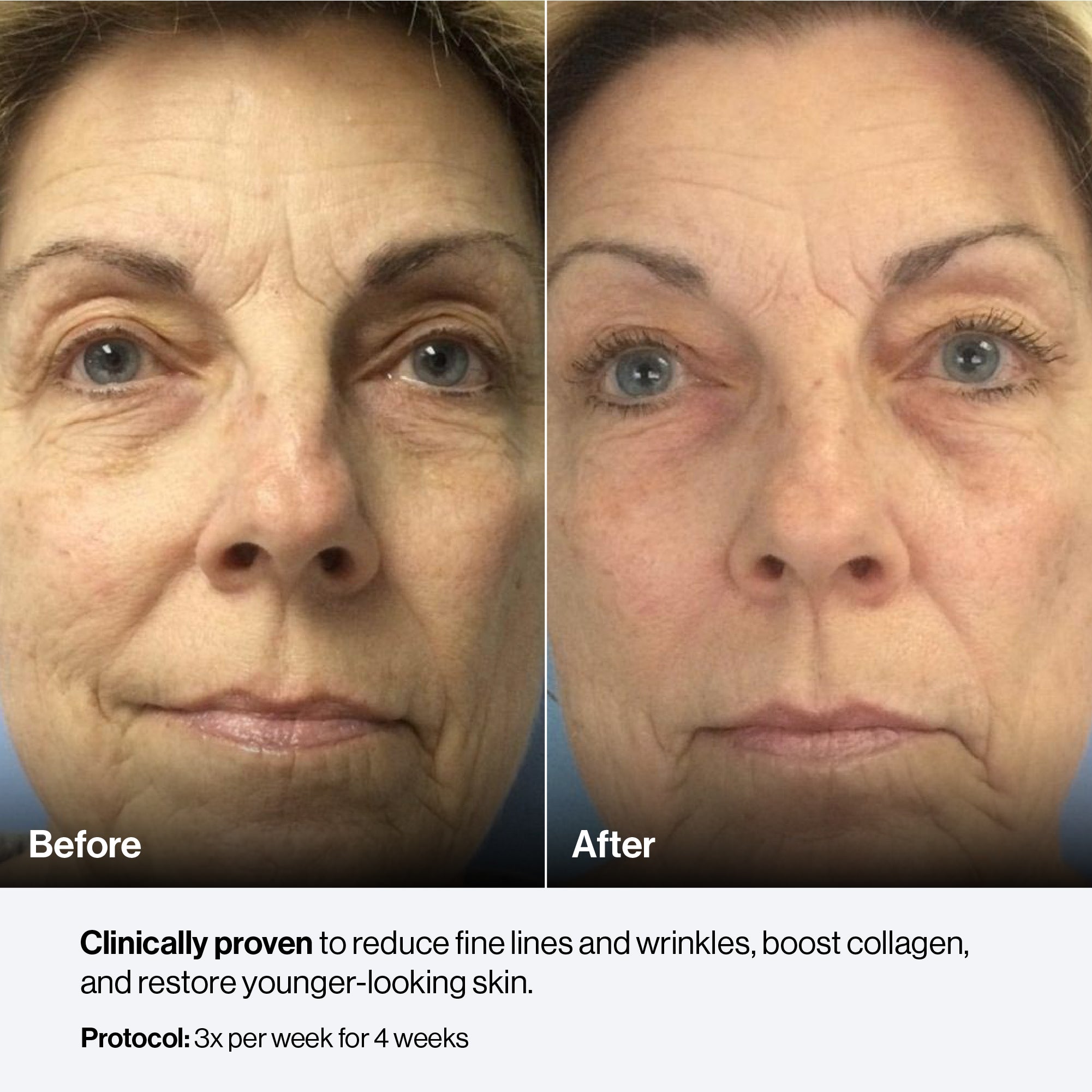 Before and after — Celluma wrinkles & healthy aging result