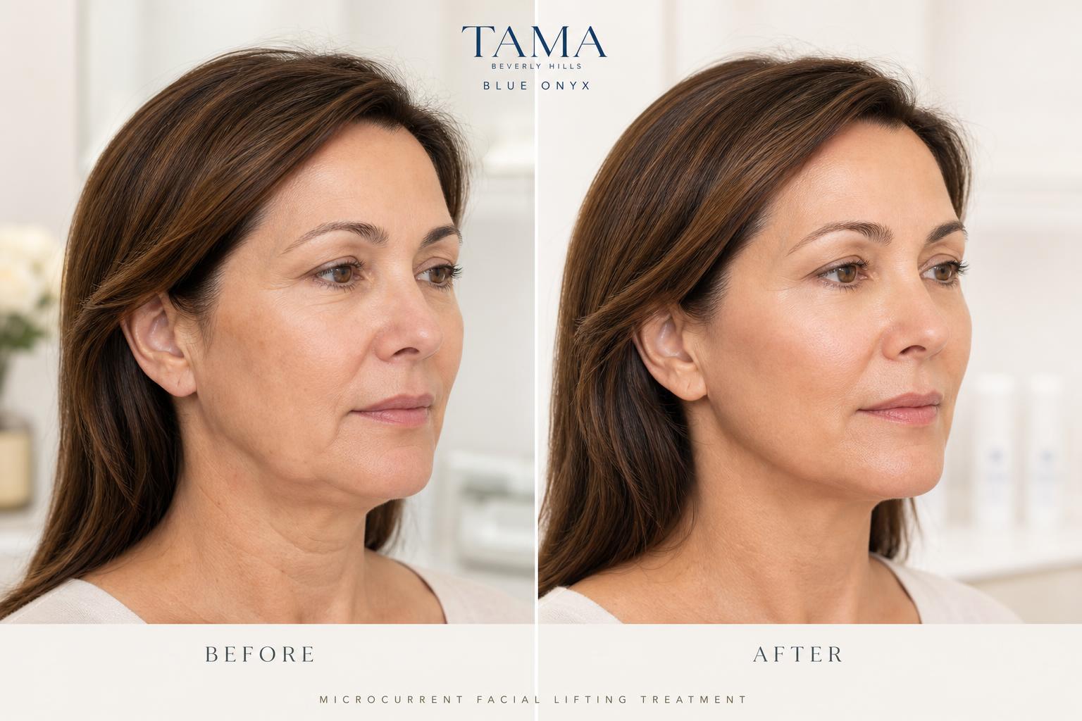 TAMA Blue Onyx vs Botox: Two Completely Different Philosophies — Not Two Versions of the Same Thing